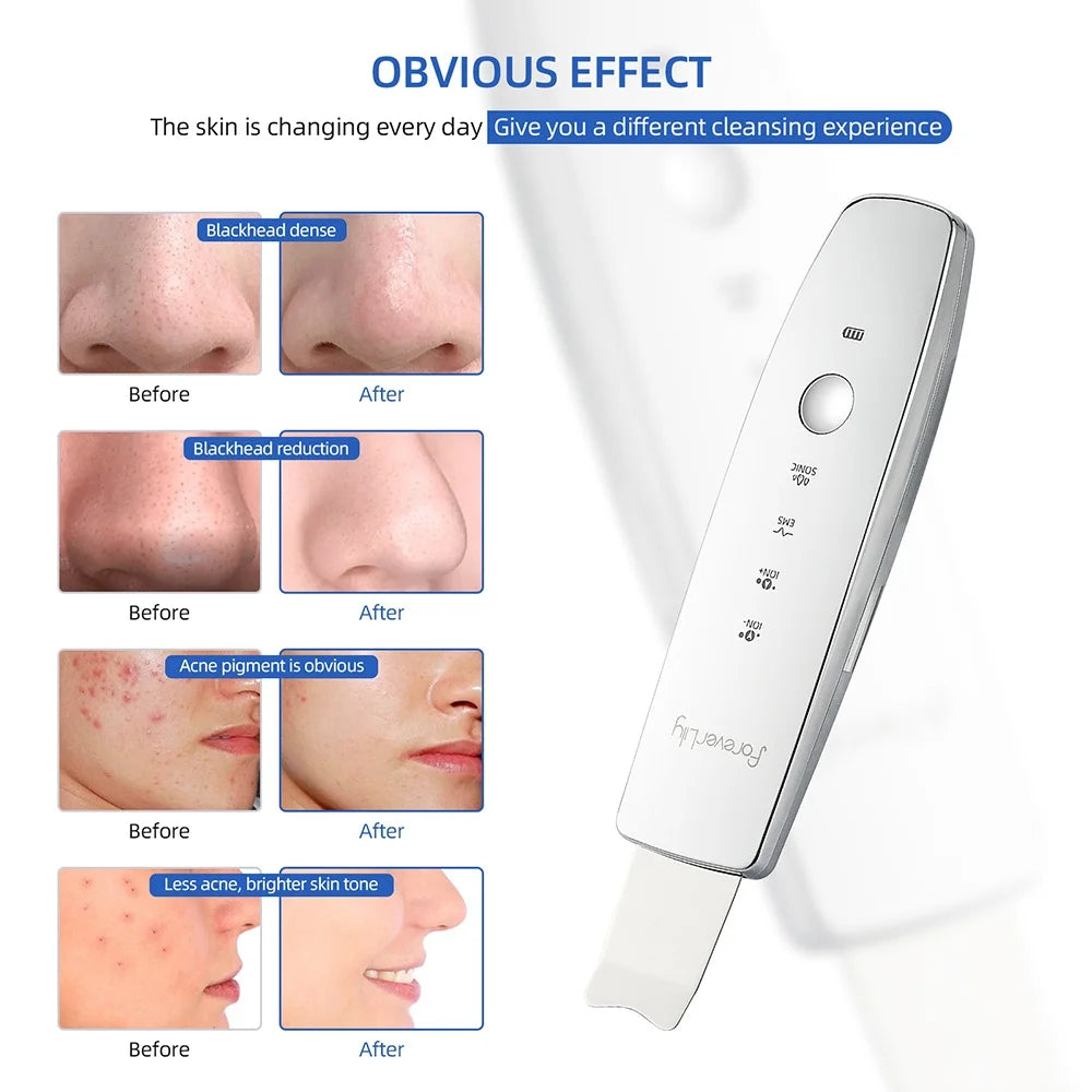 LumiSpatula – 6-in-1 Ultrasonic EMS Skin Scrubber
