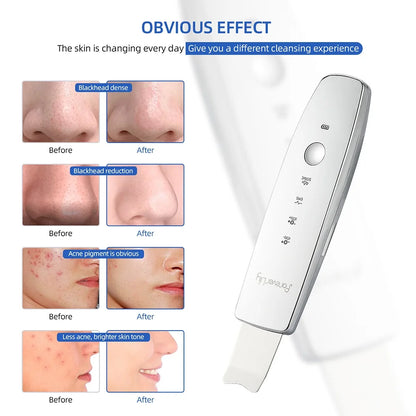 LumiSpatula – 6-in-1 Ultrasonic EMS Skin Scrubber